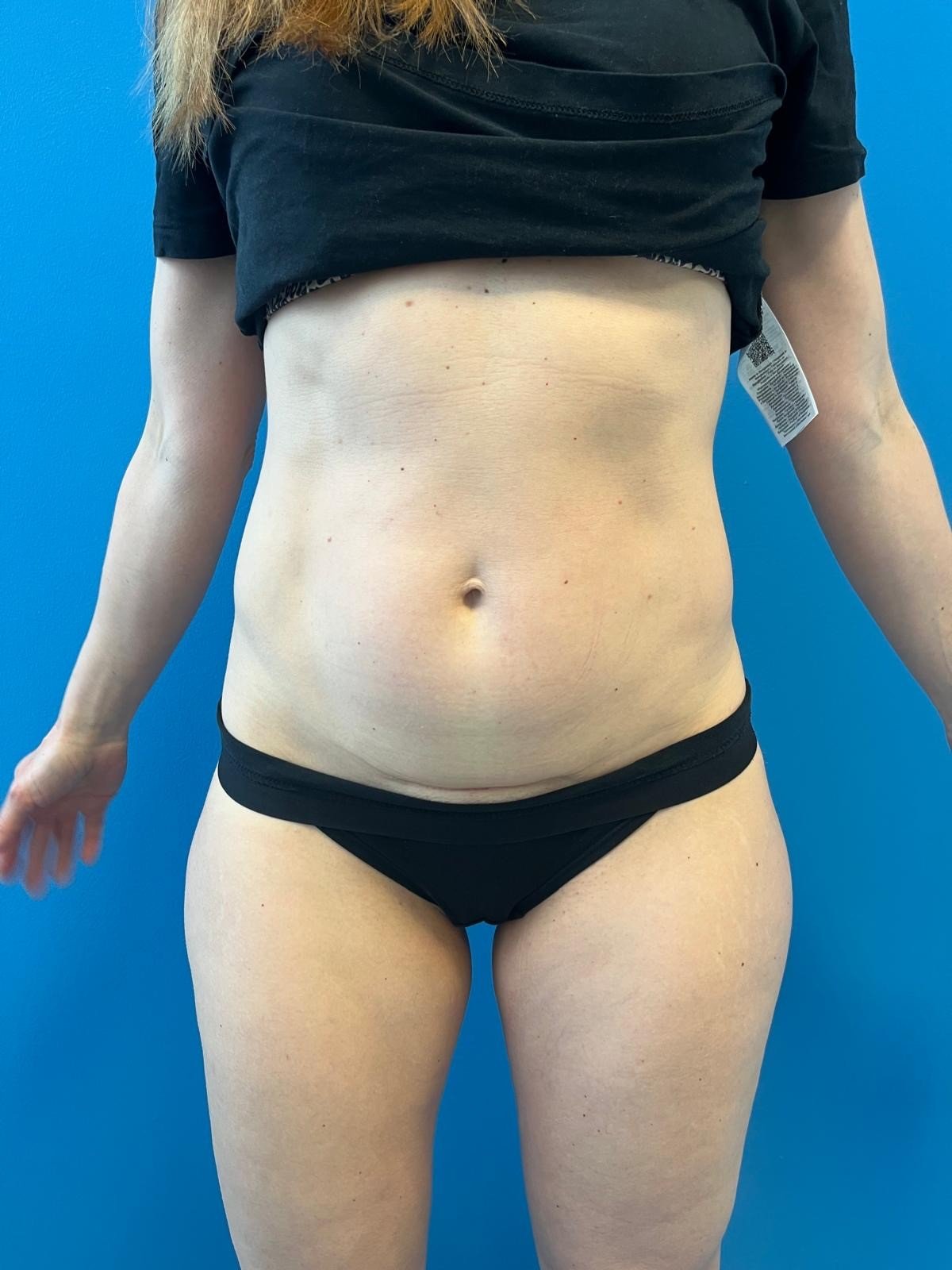 Lower abdomen liposuction - before surgery
