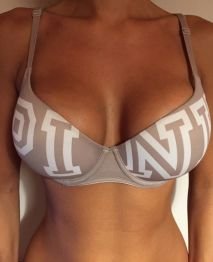 before breast augmentation1