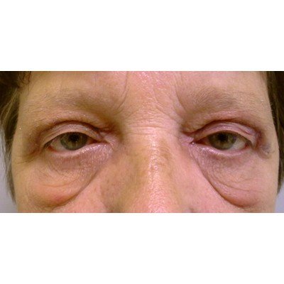 【裁断済】セレクト美容塾・眼瞼 : Eyelid surgery 裁断済】セレクト美容塾・眼瞼 : Eyelid surgery