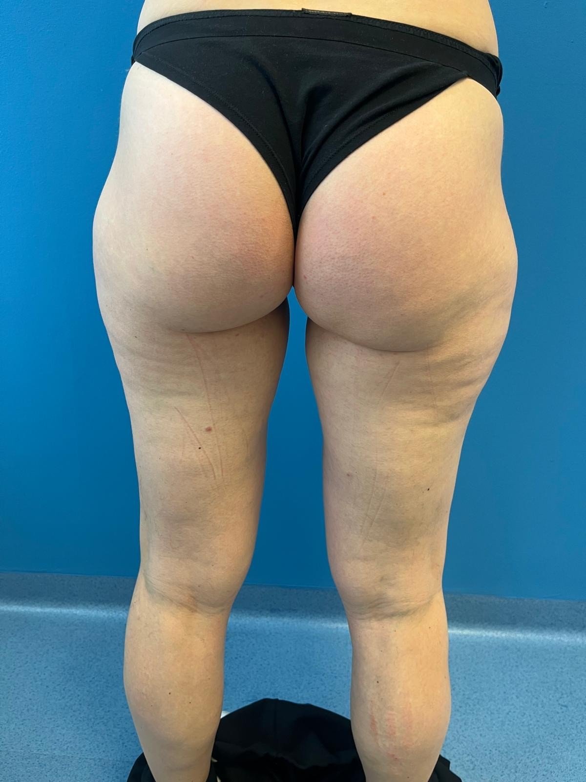 Inner and outer thigh liposuction - before surgery