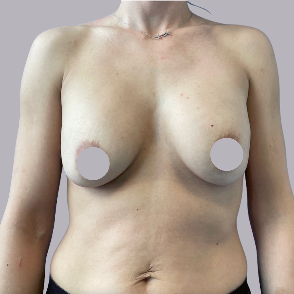 Breast Augmentation - before the procedure Breast Augmentation - before the procedure