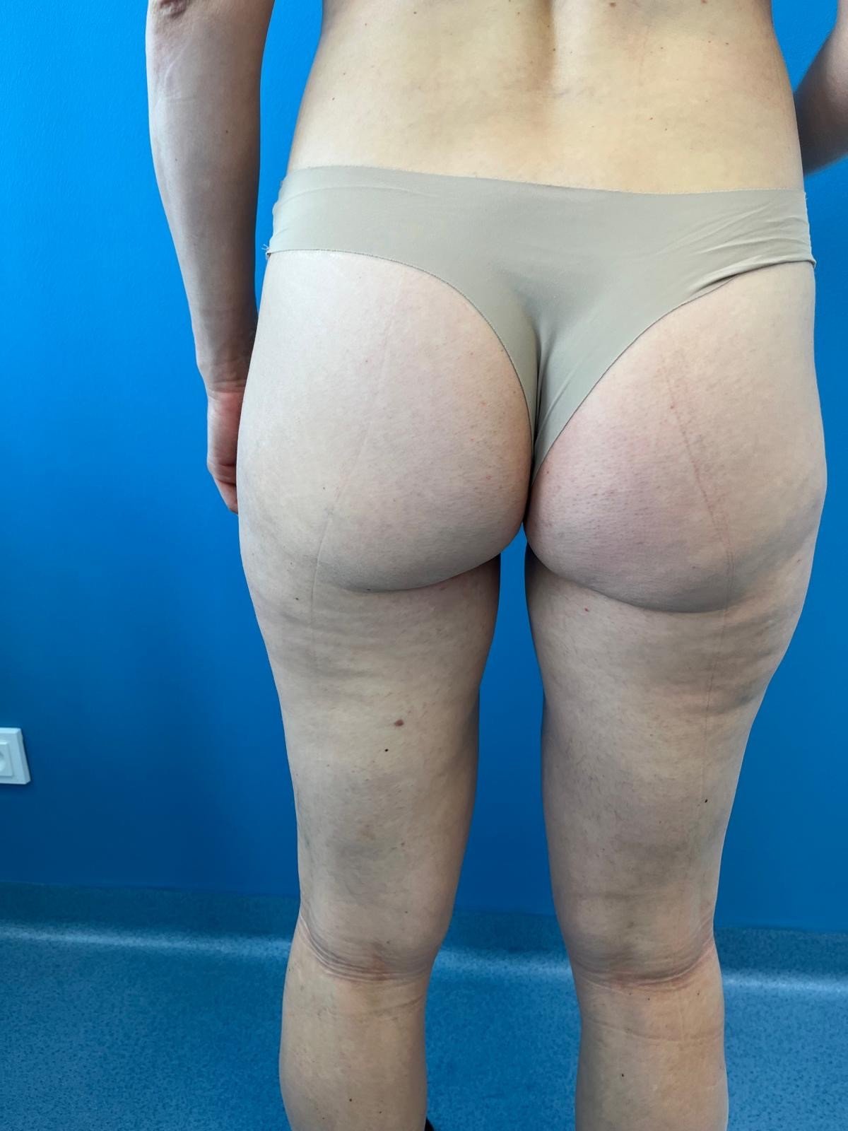 Inner and outer thigh liposuction - after surgery (6 weeks)