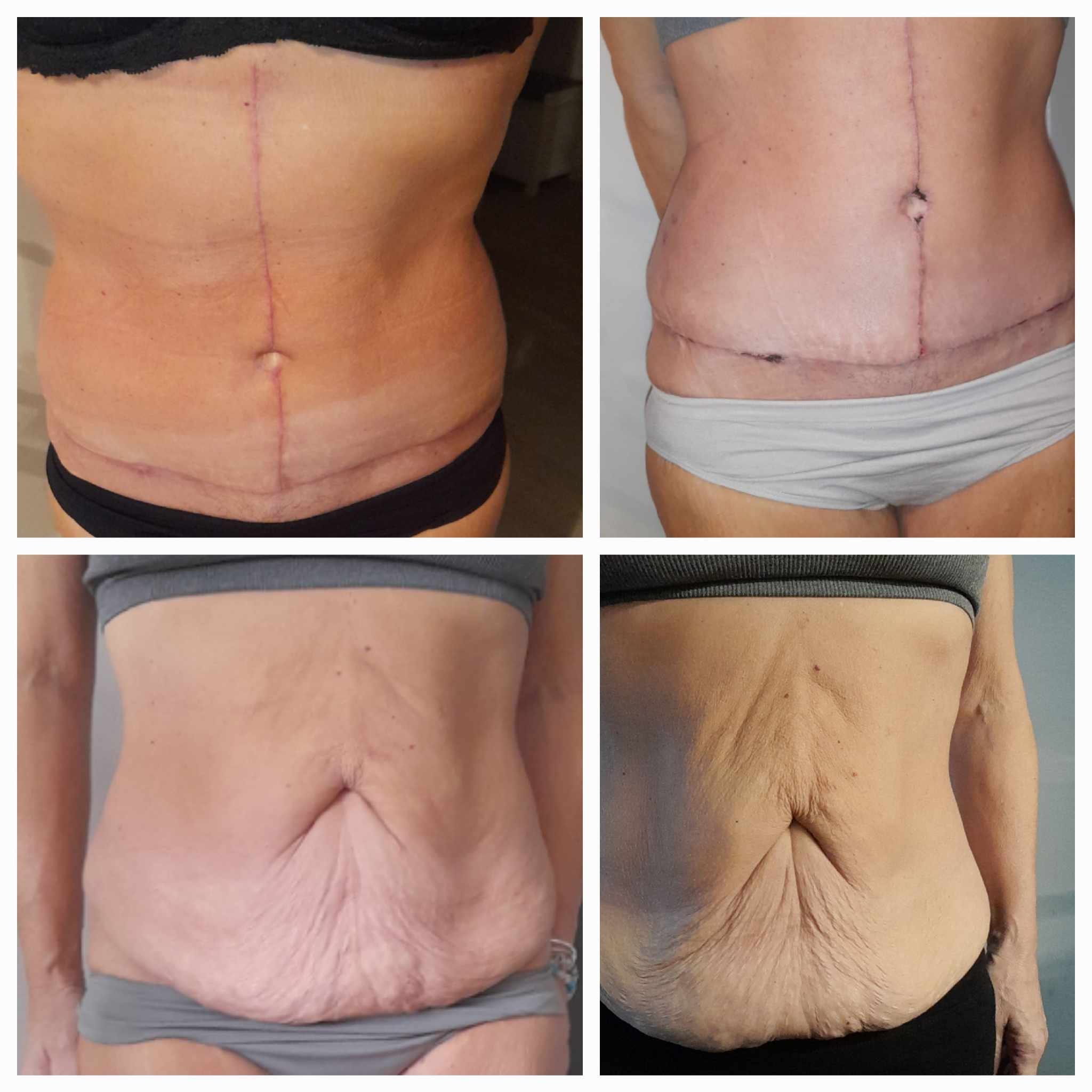 Tummy Tuck Restores Body Shape and Boosts Confidence